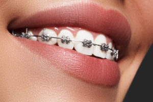 orthodontics- braces